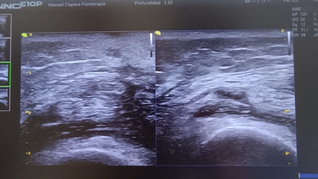 Aplicación de Cryopush en edema de rodilla.