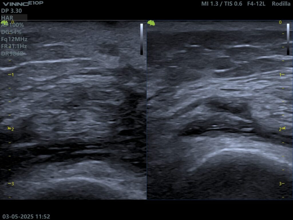 Ecografía de lesión de Ligamento cruzado anterior.